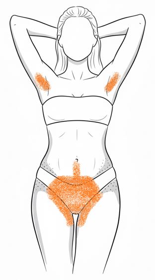 Náhľad: Bikiny zúžené + intim + podpazušie + linea alba